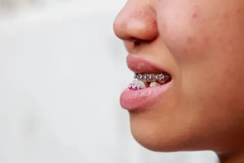 Primo piano di una bocca con apparecchio ortodontico, la **mandibola in avanti** per mostrare i denti allineati.