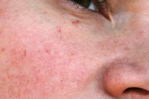 Nahaufnahme der Haut mit feinen roten Äderchen, die als besenreiser im Gesicht sichtbar sind.