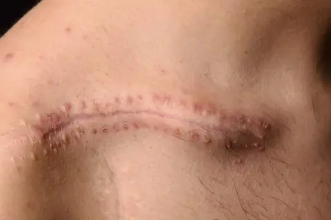 Cicatrice chirurgicale avec des points rouges, comme un fil résorbable qui ne se résorbe pas, sur une peau claire.