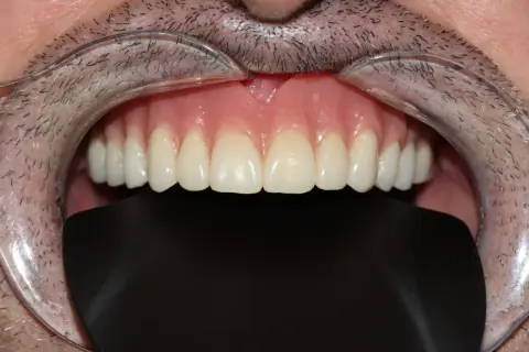 Una dentadura sin dientes, con encías rosadas y dientes postizos blancos y perfectos, se muestra en primer plano.
