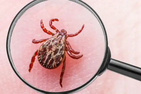 Kleszcz pod lupą. Uważaj na kleszczowe zapalenie mózgu objawy, które mogą być groźne.