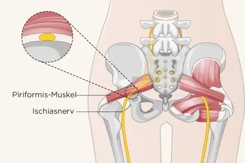 Der musculus piriformis im Beckenbereich, daneben der Ischiasnerv. Eine Nahaufnahme zeigt die Muskelfaserstruktur.