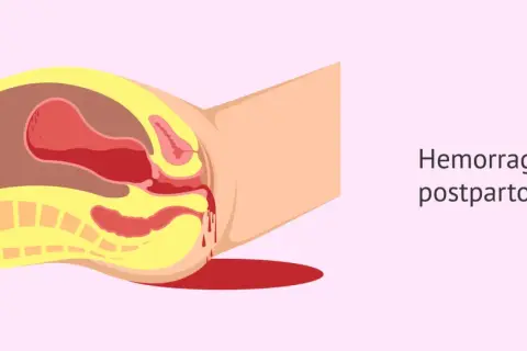 Ilustración anatómica que muestra los tipos de sangrado postparto, con sangre saliendo del útero y la vagina.