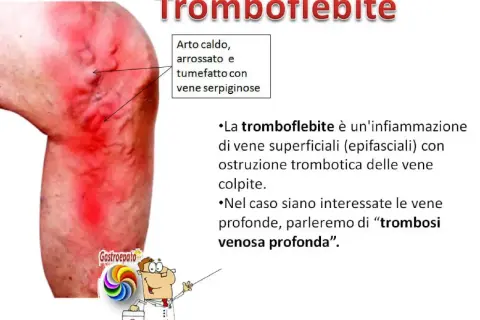Gamba con arrossamento e vene gonfie, indicativo di un calore improvviso alle gambe.