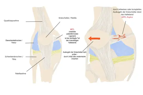 Anatomische Darstellung eines Knies, die zeigt, wie das MPFL-Band bei einer Ausrenkung der Kniescheibe reißen kann (MPFL-Ruptur).