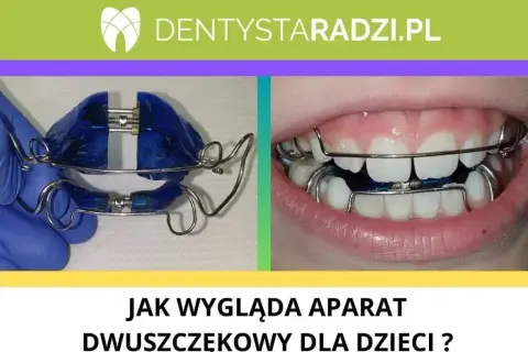 Aparat ortodontyczny z NFZ: Tylko dla dzieci? Prawda o refundacji