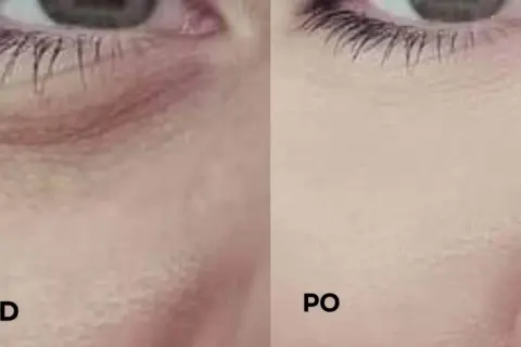Przed i po: jak dbać o skórę pod oczami, by była gładka i wypoczęta. Widoczne wygładzenie zmarszczek.