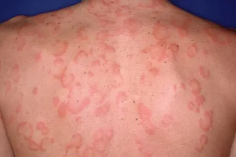 Plecy pokryte rumieniowymi, swędzącymi zmianami, przypominającymi pokrzywkę. Może to być reakcja alergiczna, np. na lek peritol.