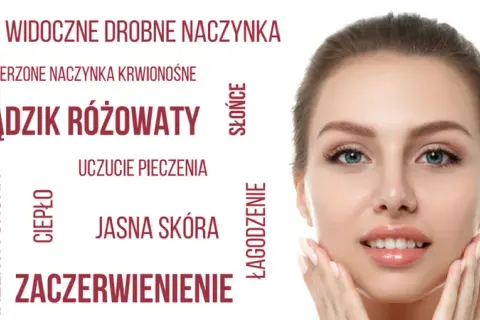 Cera naczynkowa: Jak ją rozpoznać? Uniknij trądziku różowatego!