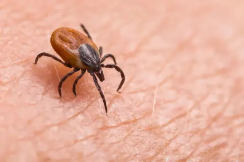 Makro zbliżenie na kleszcza wgryzionego w ludzką skórę. Pajęczak z ośmioma odnóżami przygotowuje się do pobrania krwi.
