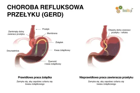 Ilustracja pokazuje prawidłowe i nieprawidłowe działanie zwieracza przełyku, wyjaśniając problem refluksu żołądka.
