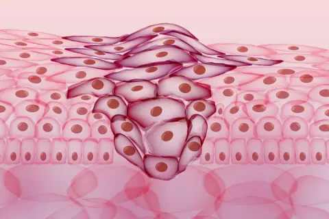 Abnormal cell growth, a concerning histologischer befund, shows invasive cells spreading through tissue layers.