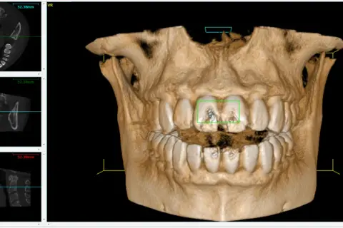 Vista 3D di denti con evidenziate aree di interesse. Si nota il canale naso palatino nelle sezioni assiale e coronale.