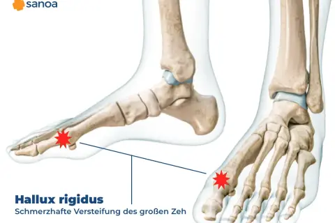 Anatomische Darstellung des Fußskeletts mit Hervorhebung des Gelenks am großen Zeh, das von Hallux rigidus betroffen ist.