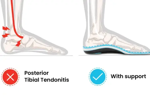 Vergleich: Entzündung des Tibialis posterior Sehnenansatzes (links, rot markiert) vs. Fuß mit Unterstützung (rechts, blaue Einlegesohle).