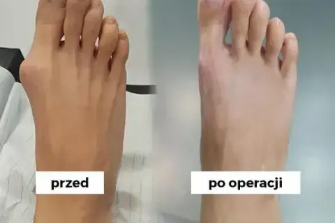 Jak długo boli po operacji haluksa? Pełen przewodnik rekonwalescencji