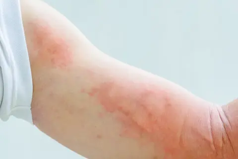 Ramię z widocznymi, rozległymi zmianami rumieniowymi, przypominającymi pokrzywkę lub reakcję alergiczną.