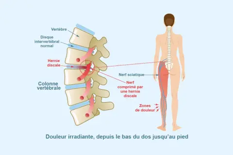 Schéma montrant une hernie discale comprimant le nerf sciatique, causant douleur irradiante dans le muscle fessier et la jambe.