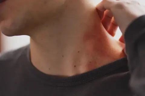Une zone de peau rouge, peut-être une vergeture rouge, apparaît sur le cou d'une personne qui se gratte.