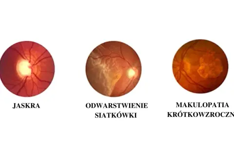 Trzy obrazy dna oka: jaskra, odwarstwienie siatkówki i makulopatia krótkowzroczna.