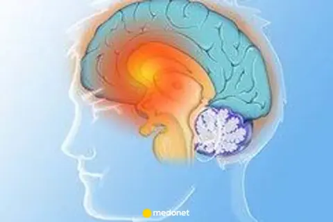 Ilustracja mózgu z zaznaczonymi obszarami, sugerującymi problemy neurologiczne, jak pląsawica choroba.