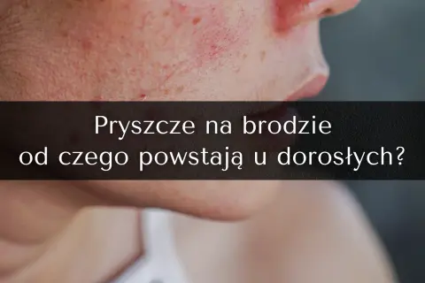 Od czego pryszcze na twarzy? Odkryj prawdziwe przyczyny i porady