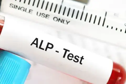 Podwyższona fosfataza alkaliczna: Co oznacza? Przyczyny i kroki