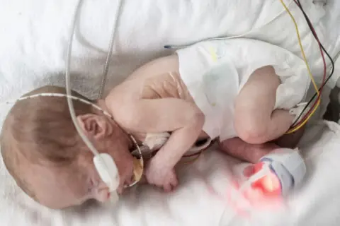 Ein winziges Baby, geboren in der 18. SSW, liegt in einem Inkubator, verbunden mit medizinischen Geräten.