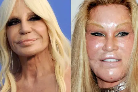 Donatella Versace i Jocelyn Wildenstein – które gwiazdy przeszły nieudane operacje plastyczne twarzy w Polsce?