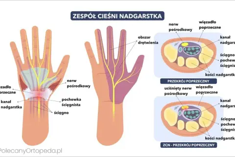 Mrowienie ręki? Cieśnia nadgarstka: Kto diagnozuje, jak leczyć?