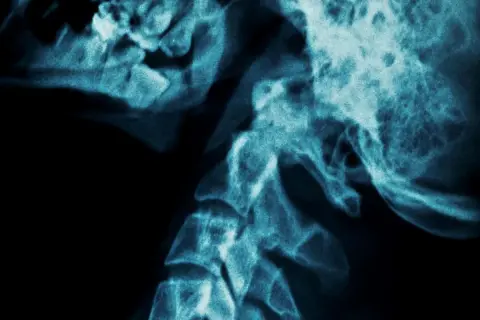 RTG kręgosłupa szyjnego. Czy rak kości jest uleczalny? Medycyna daje nadzieję, choć obraz nie pokazuje konkretnej diagnozy.