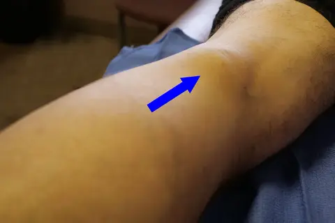 Ginocchio con freccia blu che indica un'area gonfia, possibile muscolo popliteo infiammato. Esercizi per il recupero.