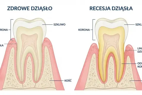 Porównanie zdrowych dziąseł i recesji. Dowiedz się, jak wzmocnić zęby i dziąsła, by uniknąć odsłonięcia korzenia.
