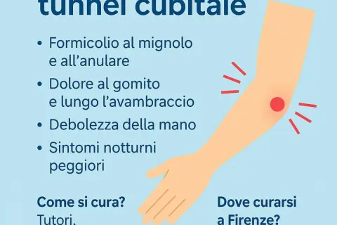 Dolore al gomito e formicolio al mignolo, sintomi del tunnel cubitale dovuti alla compressione del nervo ulnare.