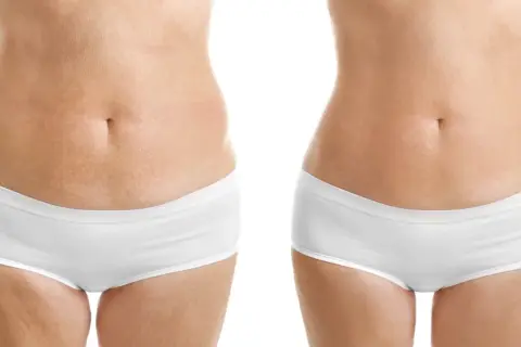 Comparativa mesoterapia corporal antes y después: abdomen más liso y tonificado.