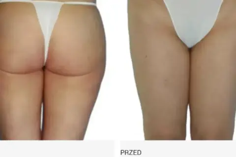 Endermologia: Jak często? Odstępy (2-3x/tydz.) dla trwałych efektów