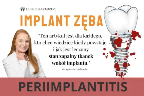 Dowiedz się, jak wyleczyć stan zapalny tkanek wokół implantu zęba. Grafika przedstawia implant zęba z krwią i uśmiechniętą dentystkę.