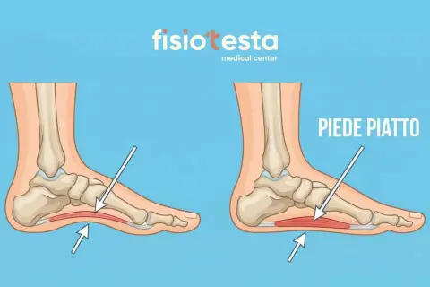 Confronto tra un piede normale e un piede piatto, evidenziando la pronazione del piede e l'appiattimento dell'arco plantare.
