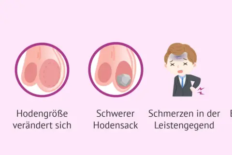 Illustration zeigt einen Hoden mit einem Knubbel, veränderte Hodengröße, einen schweren Hodensack, Schmerzen in der Leistengegend und empfindliche Brüste.
