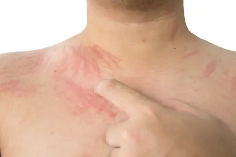 Czerwone pręgi na skórze, wynikające z dermografizmu, są widoczne na szyi i klatce piersiowej.
