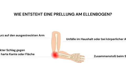 Illustration zeigt, wie **Prellungen nach Sturz** am Ellenbogen entstehen: durch Sturz auf ausgestreckten Arm, Schlag gegen harte Kante, Unfälle oder Sport.