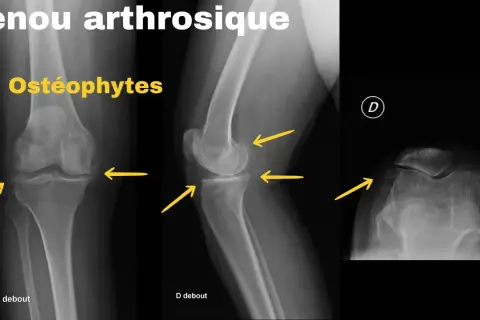 Radiographies d'un genou arthrosique montrant des ostéophytes. Le renforcement musculaire genou arthrose peut aider à gérer ces symptômes.