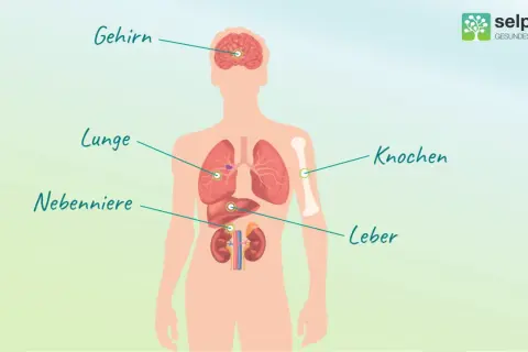 Illustration zeigt menschlichen Körper mit markierten Organen: Gehirn, Lunge, Nebenniere, Knochen, Leber. Mögliche Metastasierungsorte bei Lungenkrebs.