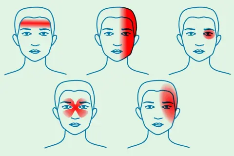 Ilustracje pokazują różne lokalizacje bólu głowy przy nerwicy: czoło, skronie, okolice oczu, cała głowa.