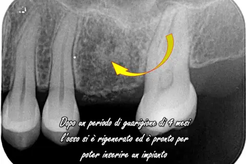 Radiografia dentale mostra rigenerazione ossea dopo displasia cemento ossea, pronta per impianto.