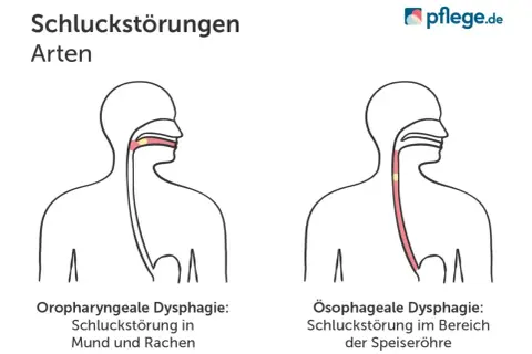 Illustrationen zeigen zwei Arten von Dysphagie: Oropharyngeale Dysphagie (Mund/Rachen) und Ösophageale Dysphagie (Speiseröhre).