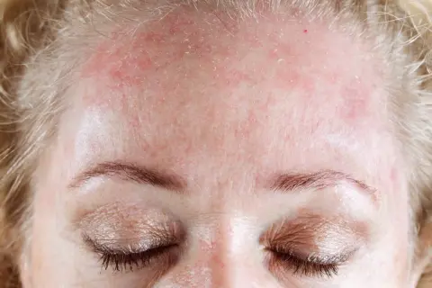 Gros plan sur le front d'une femme aux cheveux blonds, montrant une peau rouge et irritée, avec des zones de **peau qui pèle** près de la racine des cheveux.