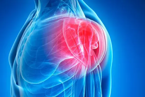 Anatomical illustration of a shoulder with inflamed bursa highlighted in red.