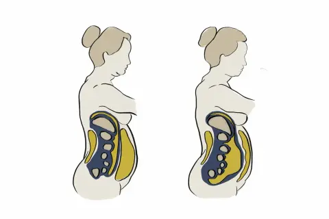 Vergleich zweier Bauchprofile: Links ein vollerer Bauch mit sichtbarem Bauchfett, rechts ein schlankerer Bauch. Mögliche hormonelle Einflüsse auf den Bauch werden angedeutet.