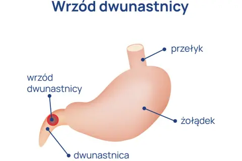 Jakie są objawy wrzodu dwunastnicy? Poznaj niebezpieczne sygnały